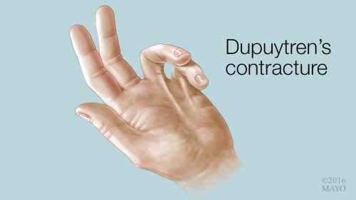 Dupuytren contracture